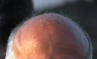 Scientists in Texas Discover What’s Behind Graying and Baldness
