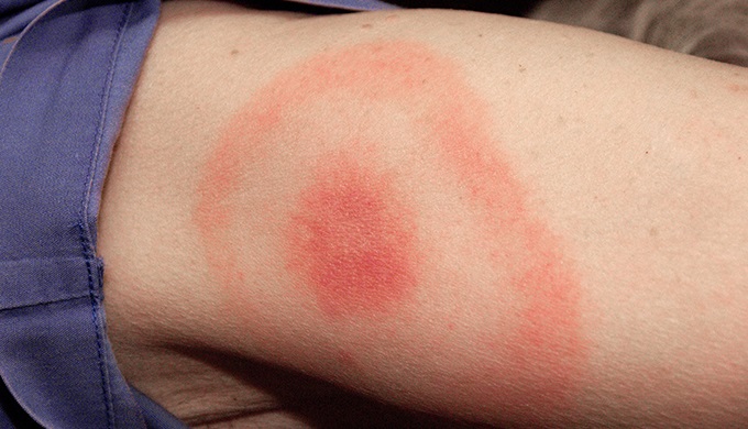 A Red Bullseye Rash Commonly Seen in Lyme Disease