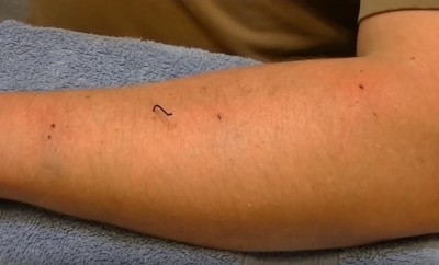 Small fish hook in arm
